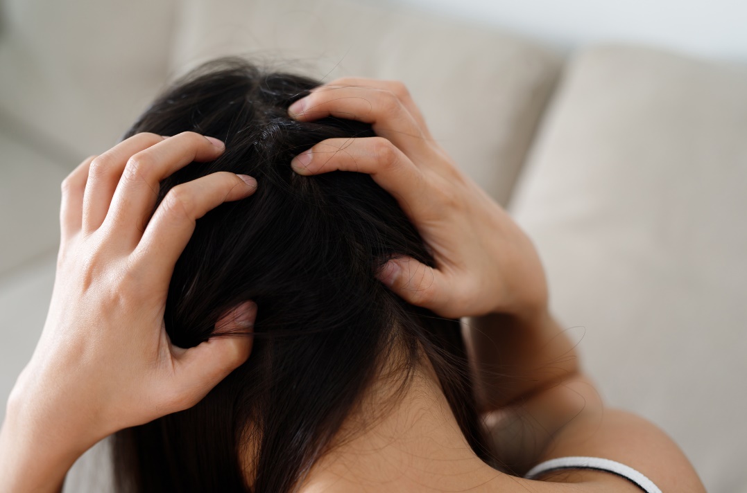 remédio caseiro para caspa